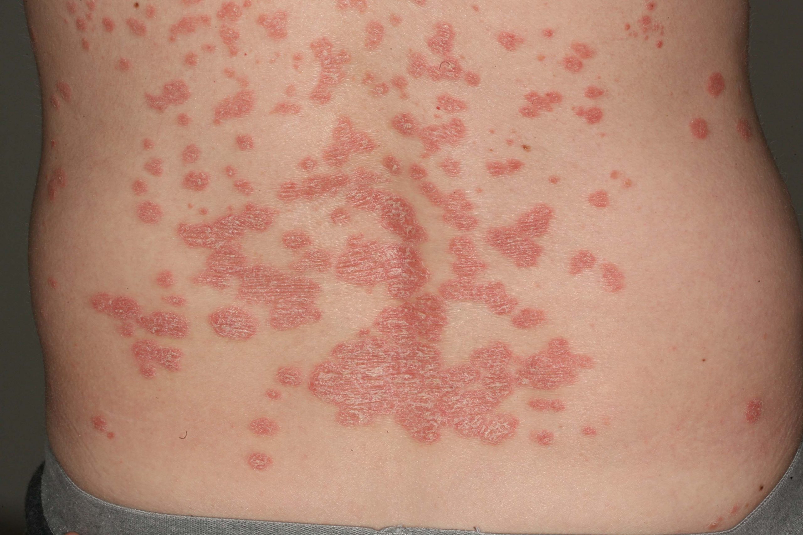 How To Stop Guttate Psoriasis Spreading