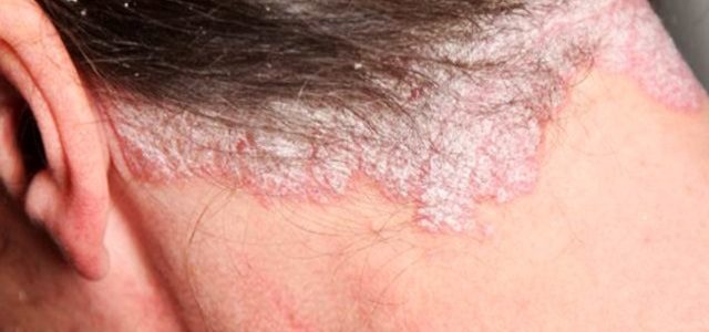 How To Stop Psoriasis On Scalp