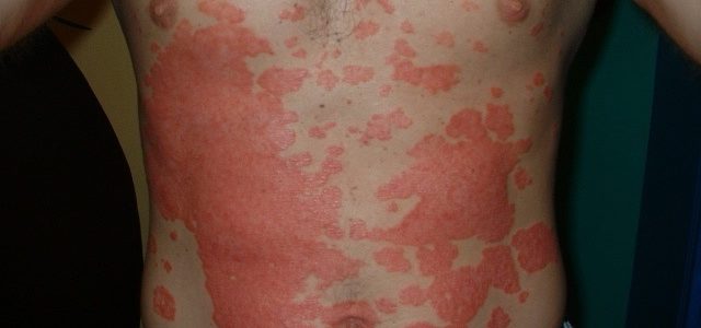 How To Stop Psoriasis Spreading