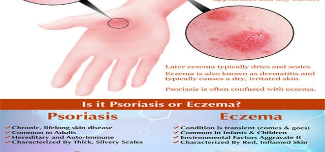 How To Tell If You Have Psoriasis Or Eczema