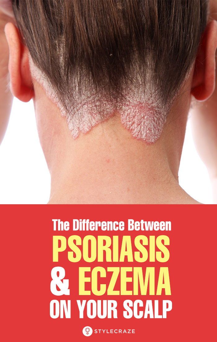 How To Tell The Difference Between Psoriasis And Eczema On Your Scalp ...