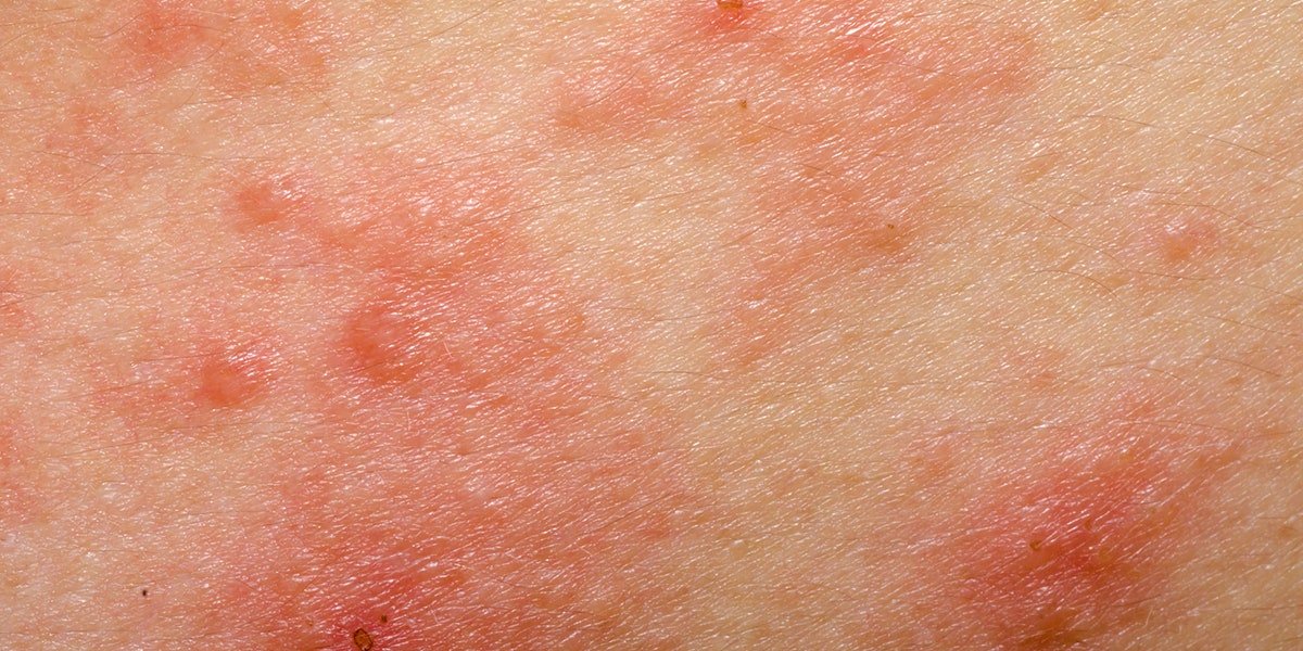 How to Tell the Difference Between Psoriasis and Eczema