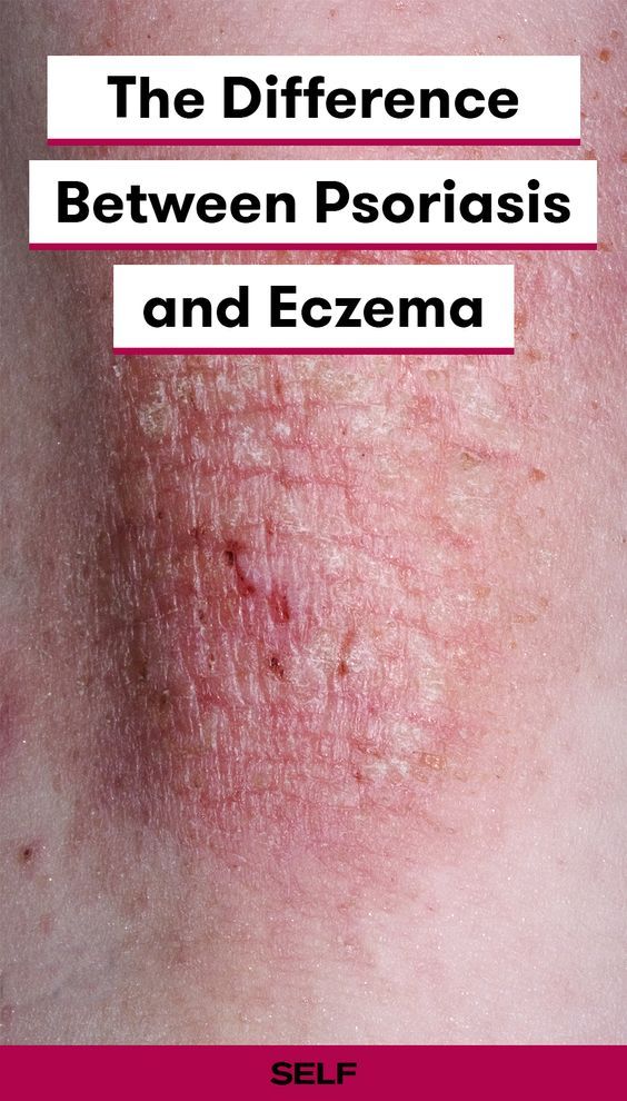 How to Tell the Difference Between Psoriasis and Eczema ...