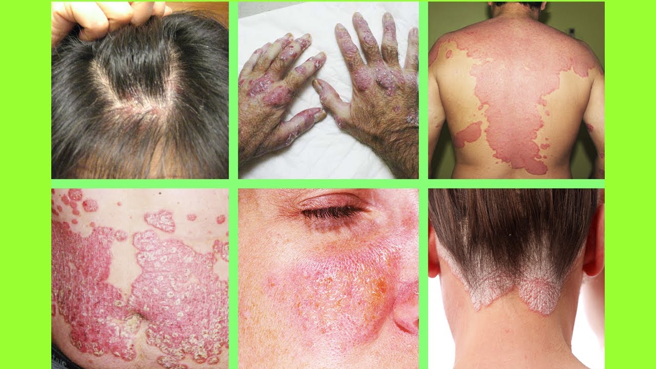 How To Treat Plaque Psoriasis Naturally