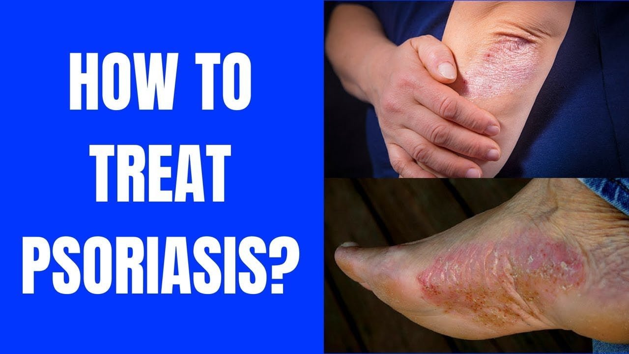 How To Treat Psoriasis