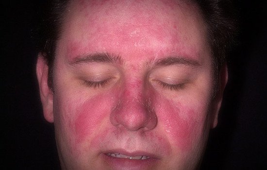 How To Treat Psoriasis In The Face