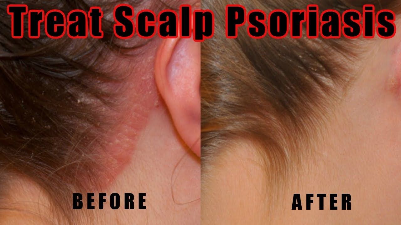 How to Treat Scalp Psoriasis  5 Natural Ways for Treating ...