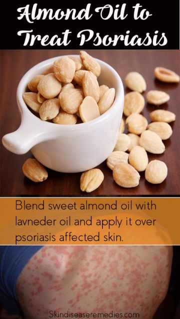 How to Use Almond Oil for Psoriasis (7 DIY Recipes ...