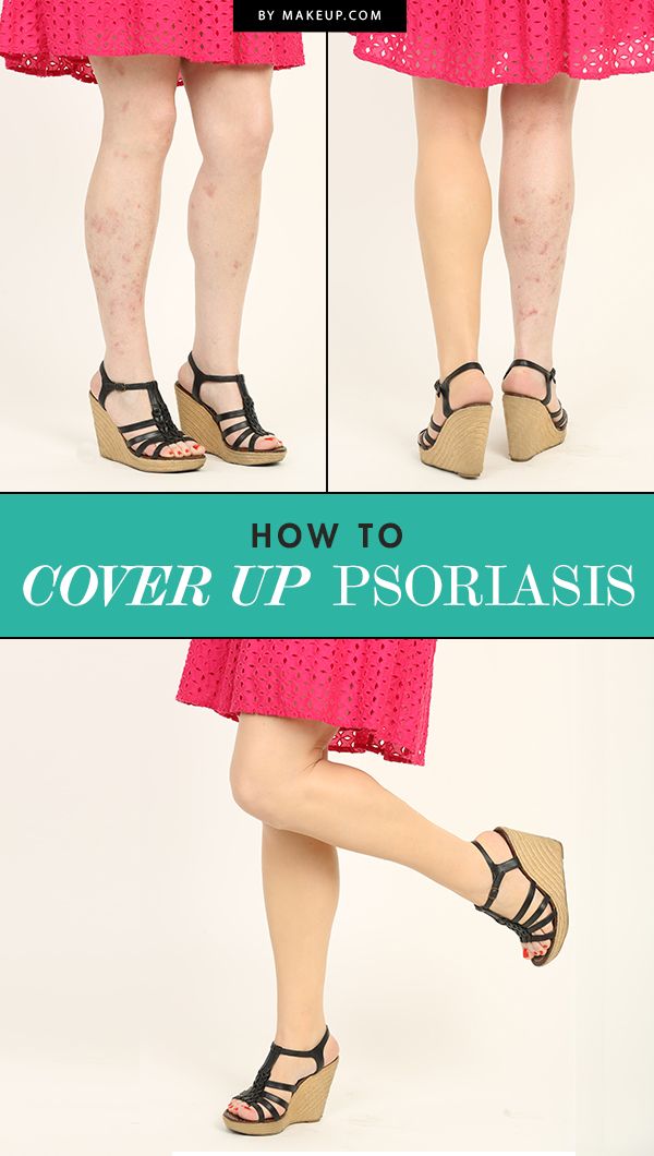 How to Use Makeup to Cover Up Psoriasis