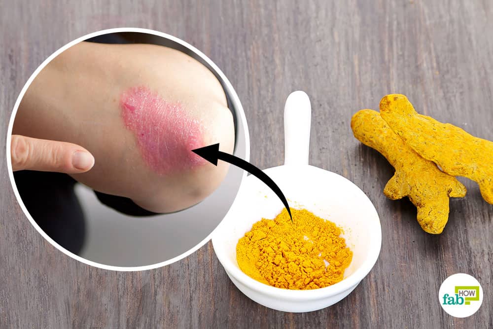How to Use Turmeric for Psoriasis