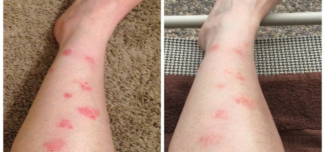 Humira Psoriasis Side Effects
