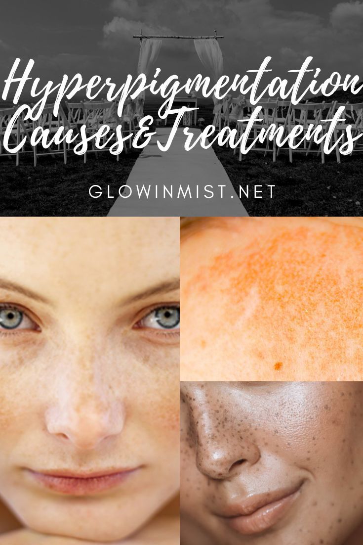 Hyperpigmentation is any condition that leads to ...