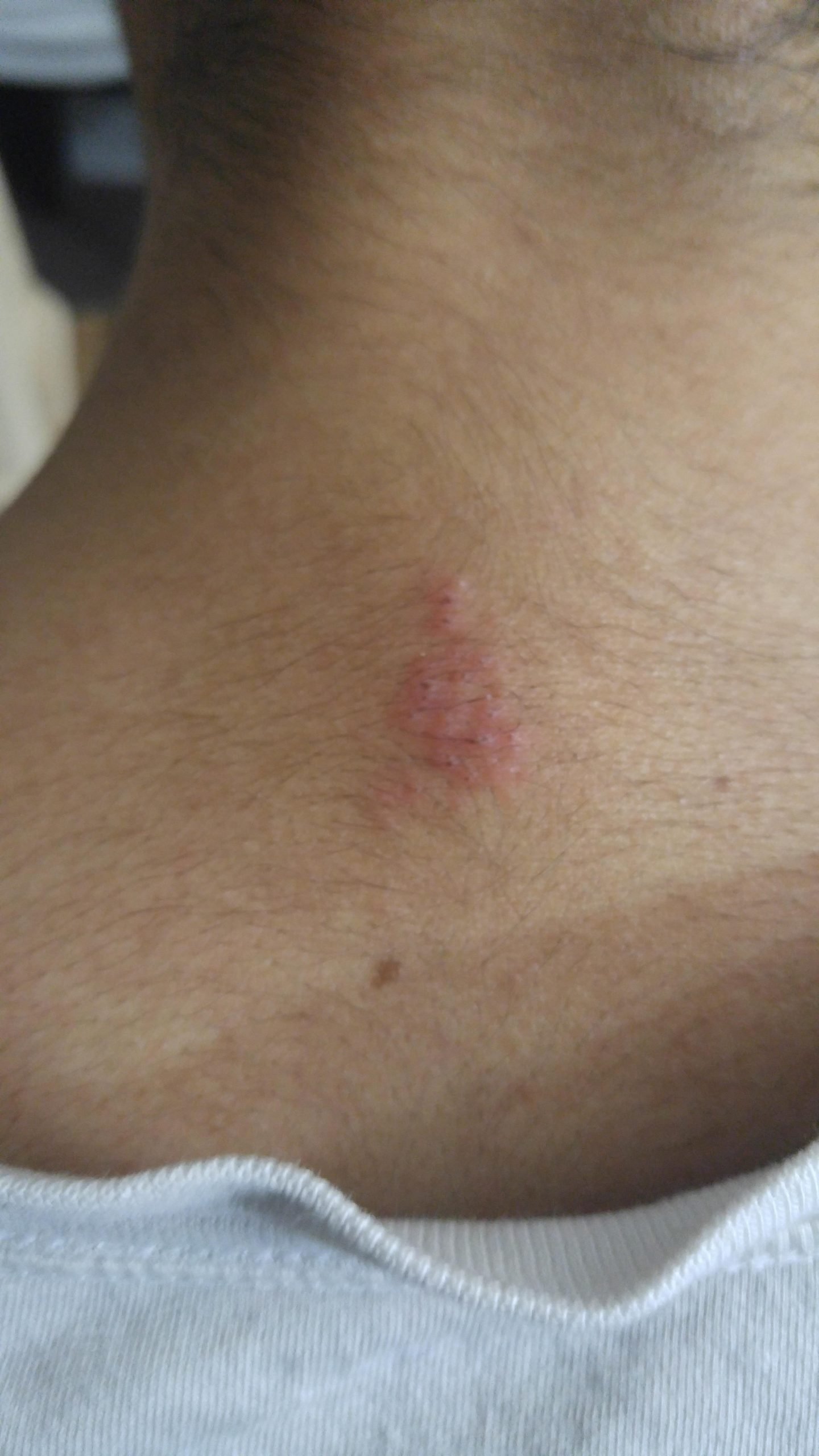 I noticed this a couple of days ago on my upper neck/back area. I have ...