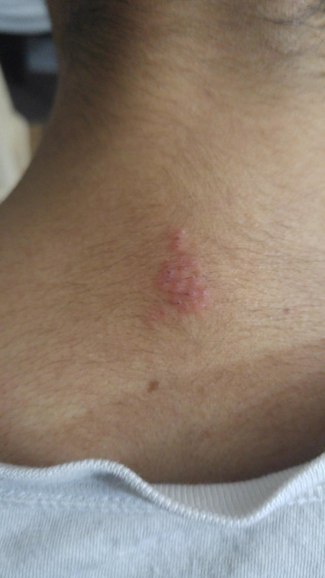 I noticed this a couple of days ago on my upper neck/back ...