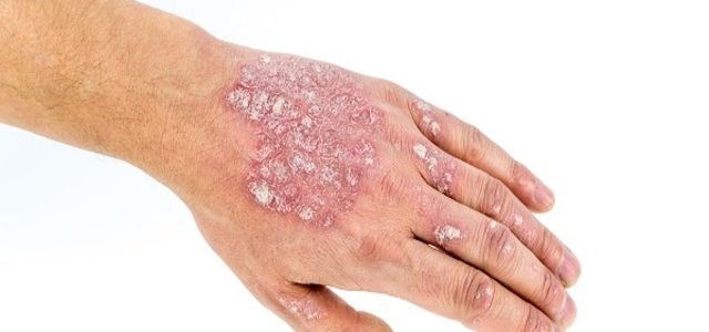 Images Of Plaque Psoriasis On Hands