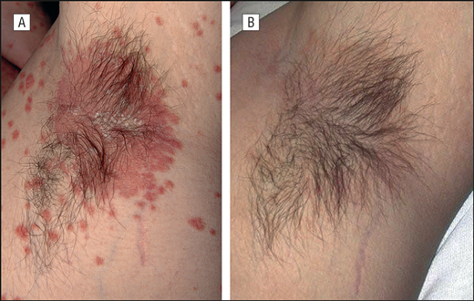 Inverse Psoriasis and Hyperhidrosis of the Axillae Responding to ...