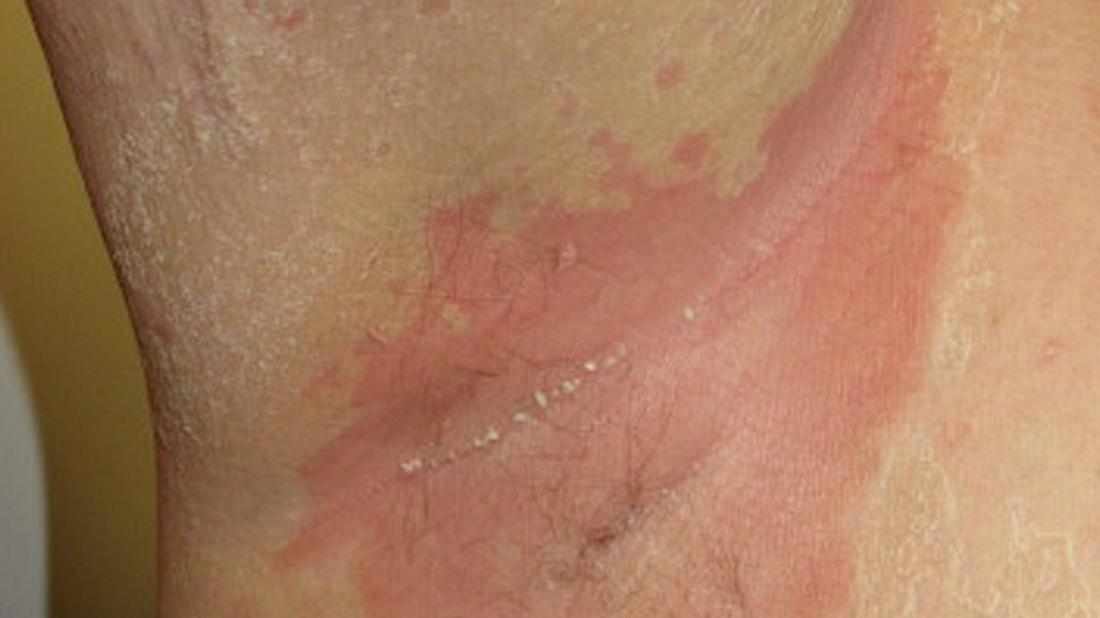 Inverse psoriasis: Causes, symptoms and when to see a doctor