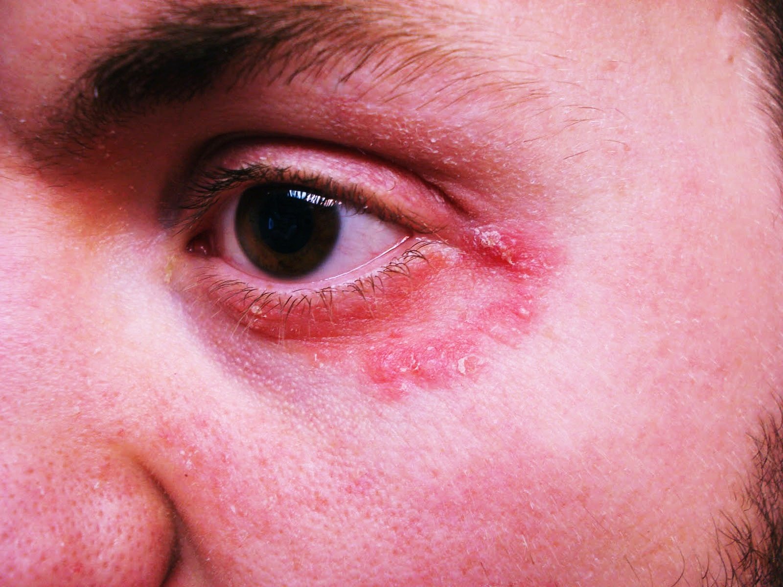 Irritation Under Eyelid