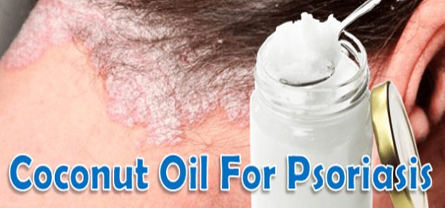 Is Coconut Oil Good For Psoriasis Of The Scalp