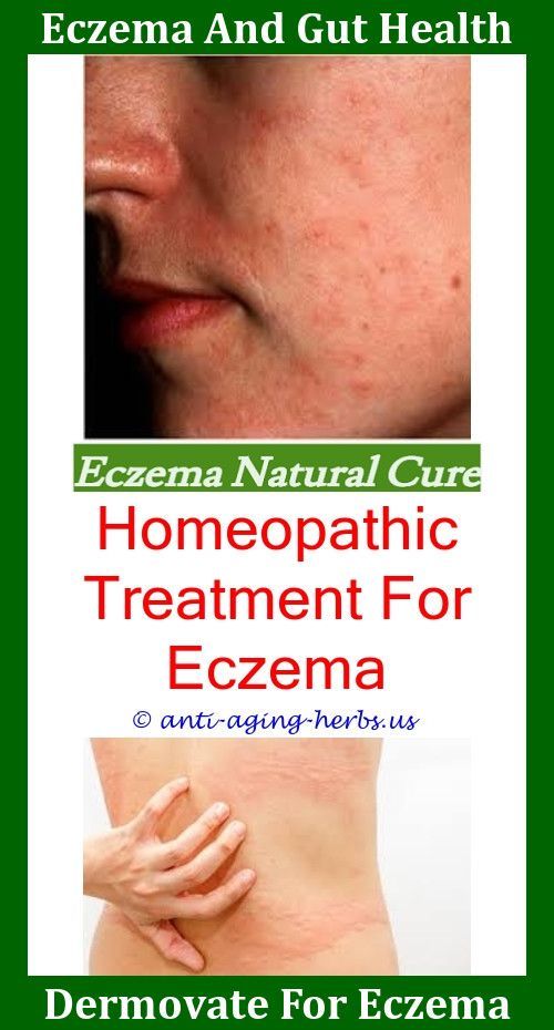 Is Eczema A Skin Disease Moogoo Eczema,can you get eczema on your neck ...