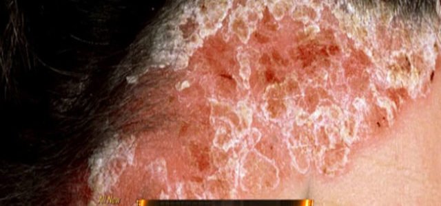 Is Psoriasis On The Scalp Contagious