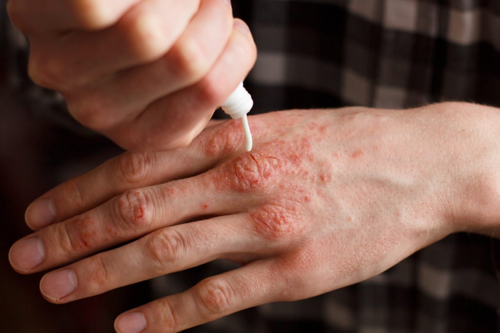 Is Psoriasis Remission Possible? 3 Surprising Approaches