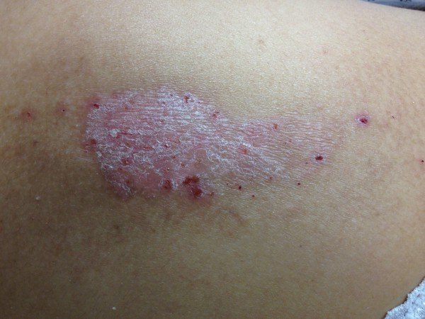 Is That Dry Skin Patch Plaque Psoriasis?  LCI Mag