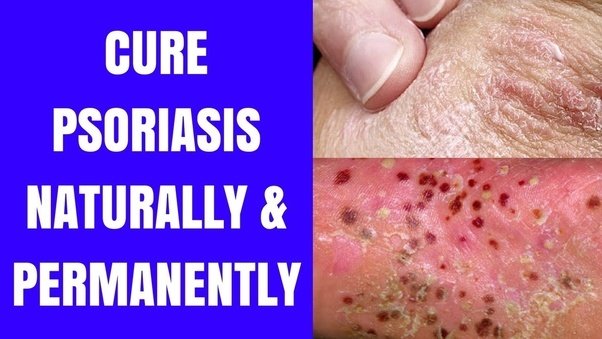 Is there a permanent cure for psoriasis?