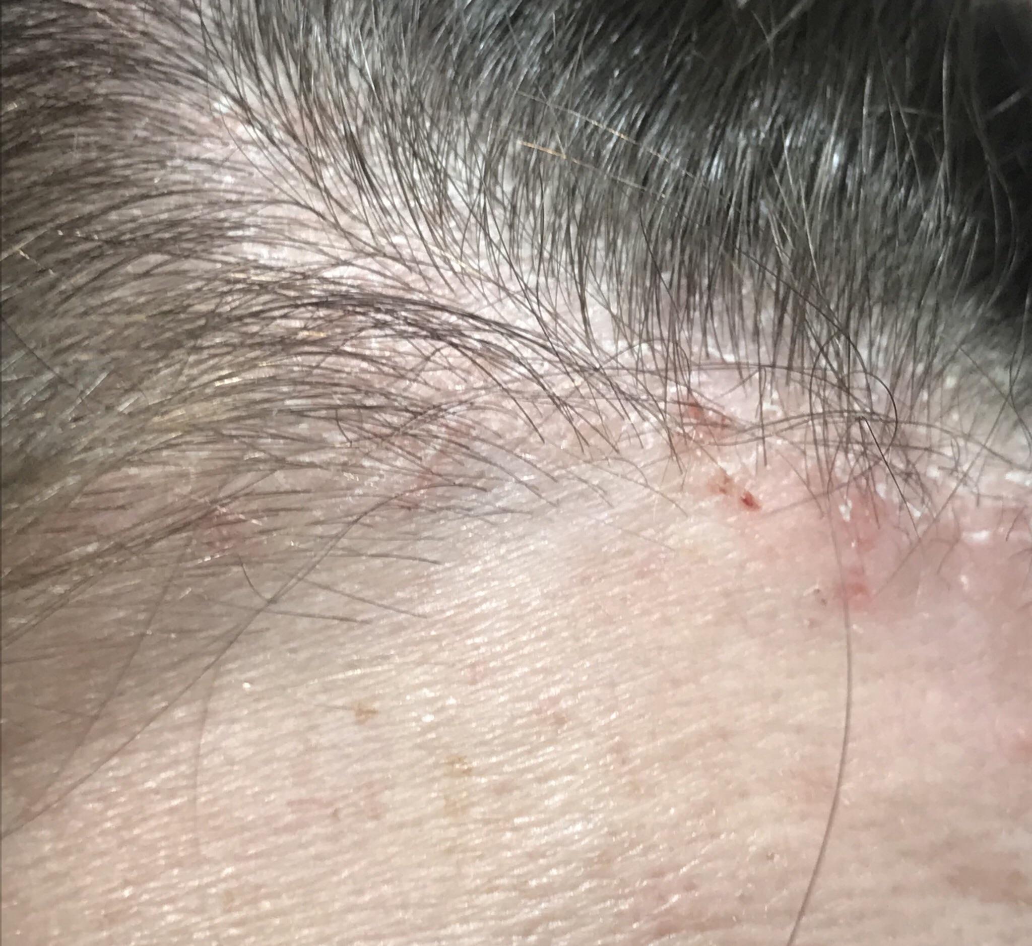 Is this dry scalp, psoriasis, or something else? This is a ...