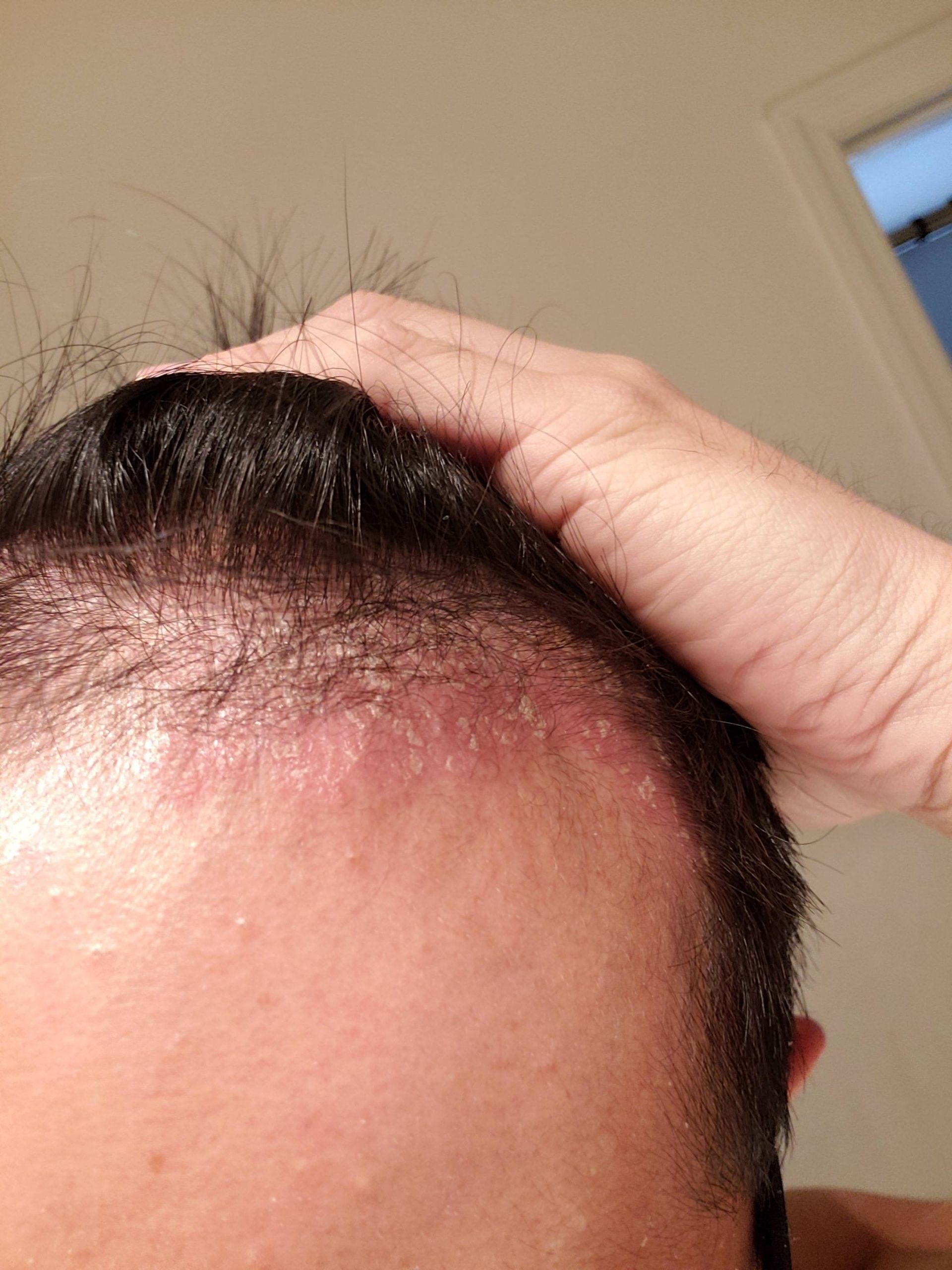 Is this scalp psoriasis : Psoriasis