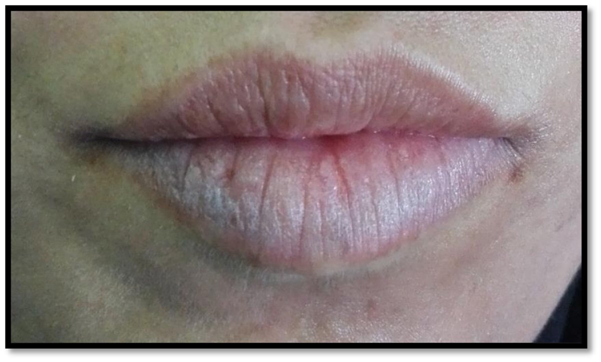 Isolated lip involvement in psoriasis: an uncommon aspect of a common ...