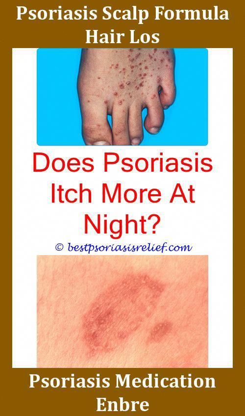 Ispsoriasiscontagious Uv Lamp For Psoriasis,humirapsoriasis why does ...