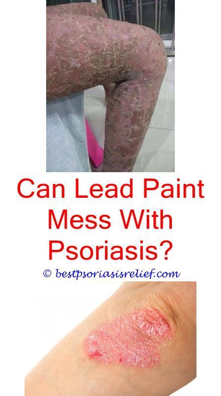 ispsoriasisgenetic what age can you get psoriasis