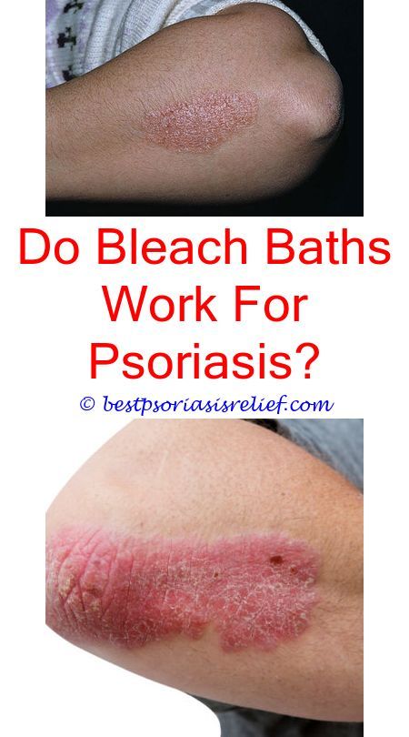ispsoriasishereditary coconut oil for plaque psoriasis ...