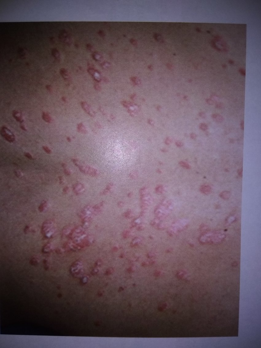 It shows the late stages of Guttate Psoriasis where the droplets spread ...