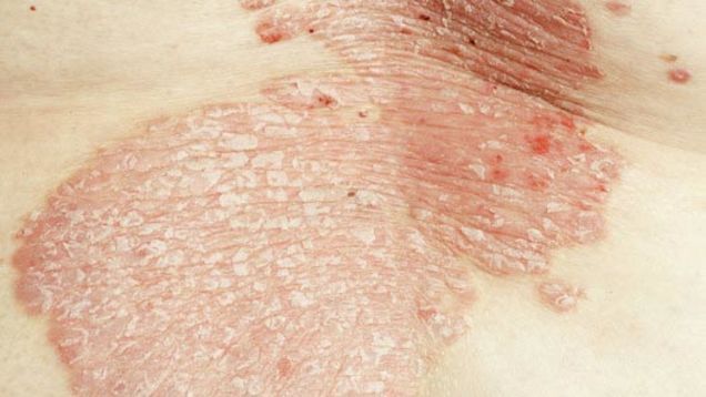Itchy Rash: Is It Psoriasis or Something Else?