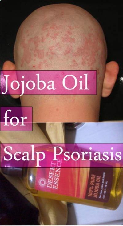 jojoba oil for scalp psoriasis