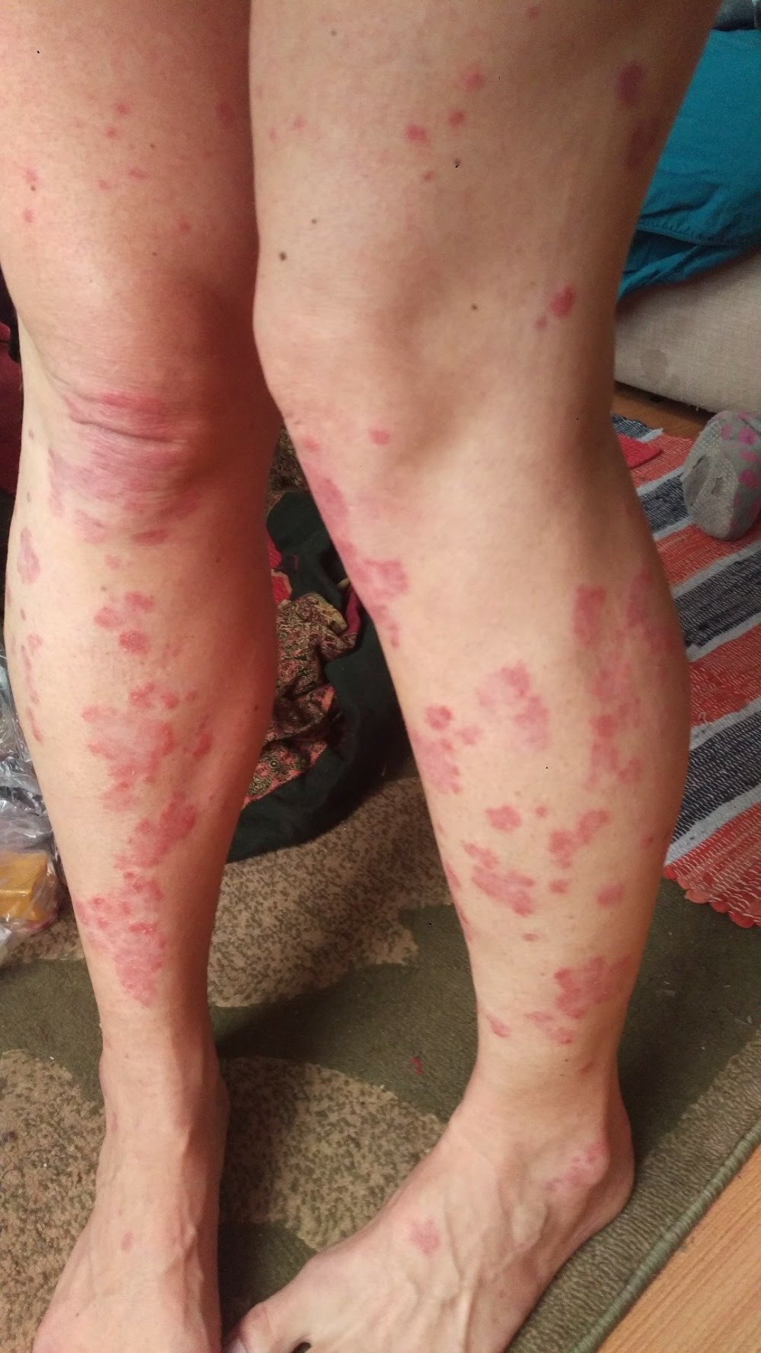 Keto Diet for Psoriasis Success Stories