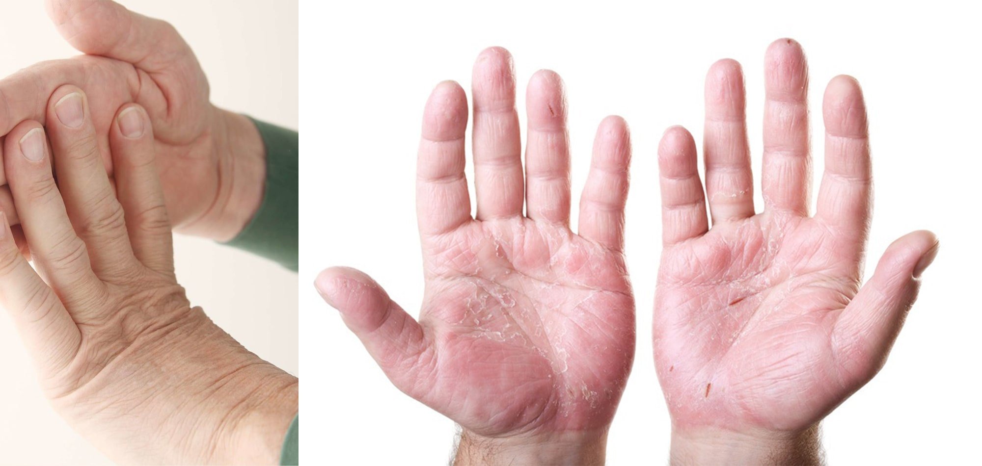 Know More About Psoriasis Disease, Eczema, Fungal Infection