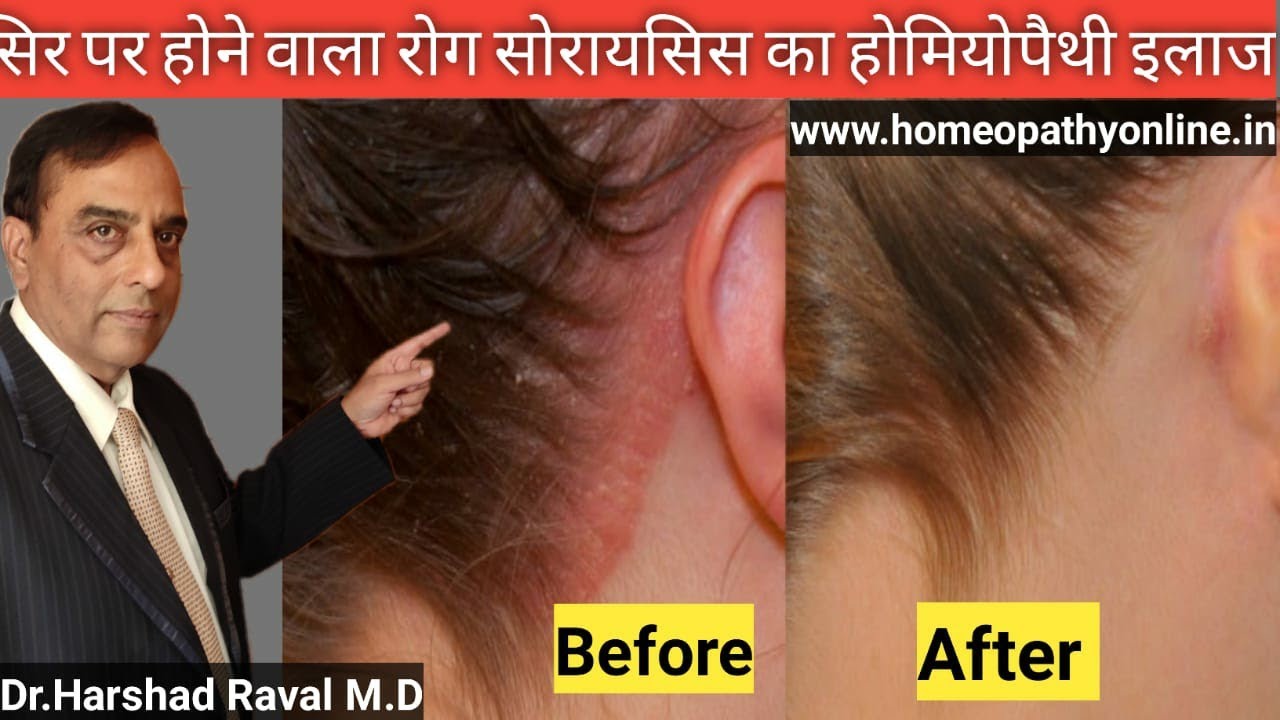l Homeopathy Treatment For Scalp Psoriasis in ...