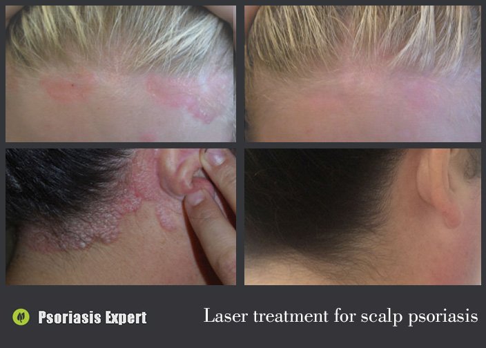 laser treatment for scalp psoriasis