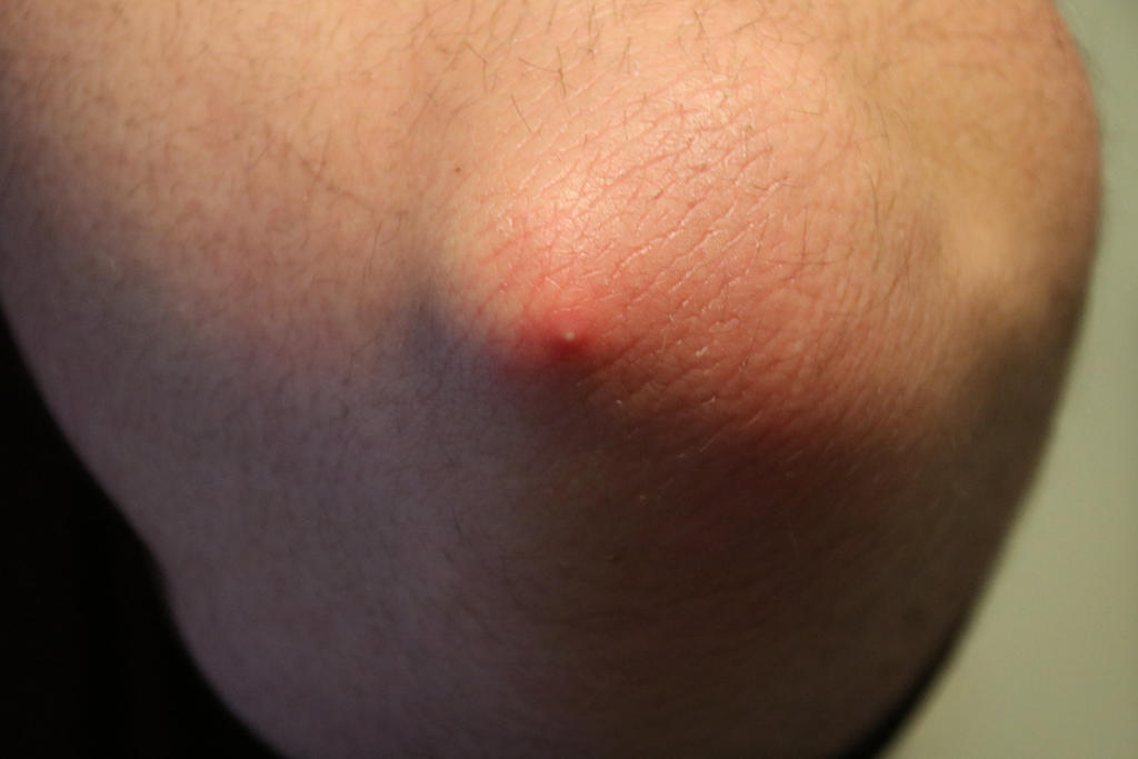 Left Elbow Pimple by MJMSTUDIOS2020 on DeviantArt