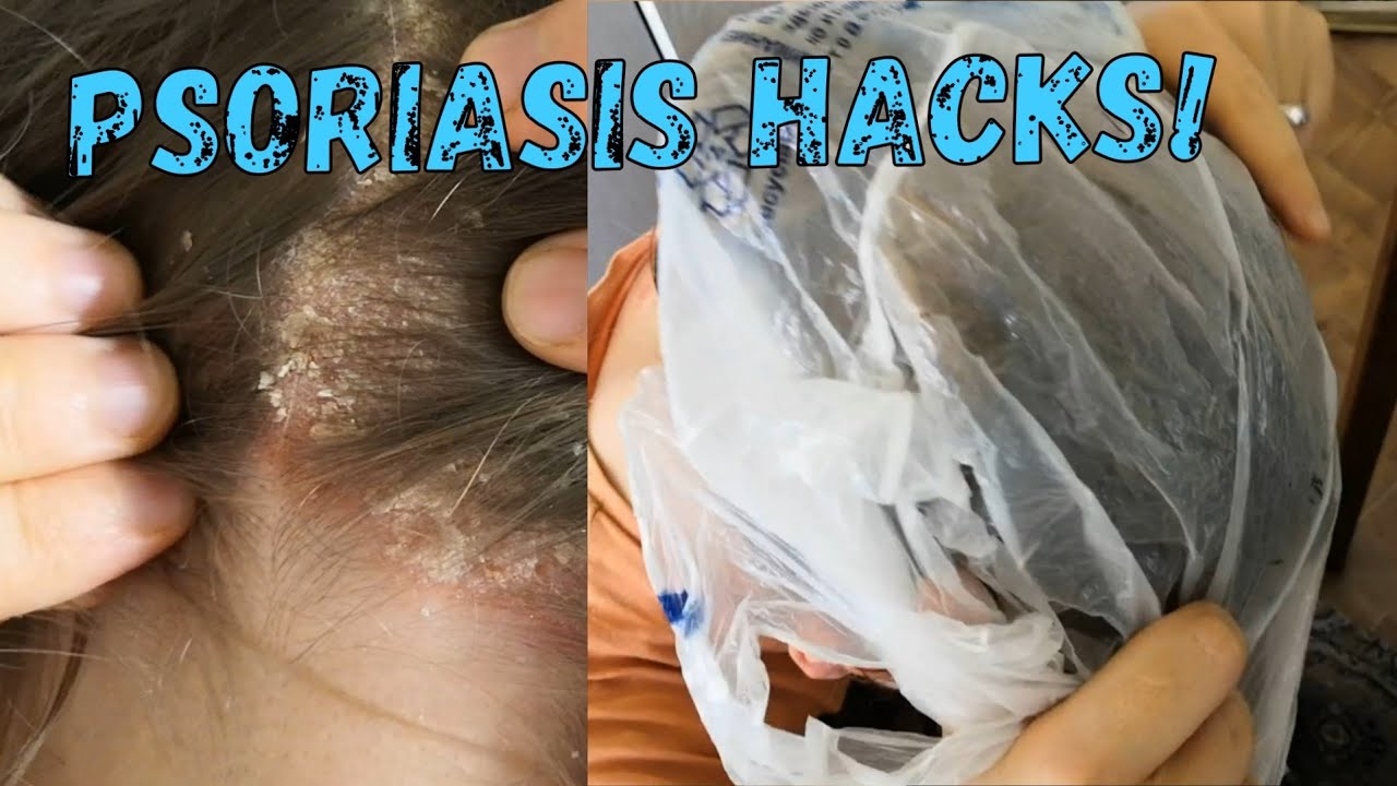 LIFESAVING HACKS to deal with SEVERE psoriasis and ITCHY ...