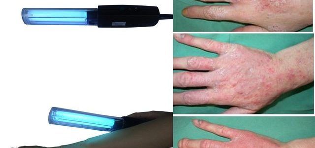 Light Treatment For Psoriasis At Home