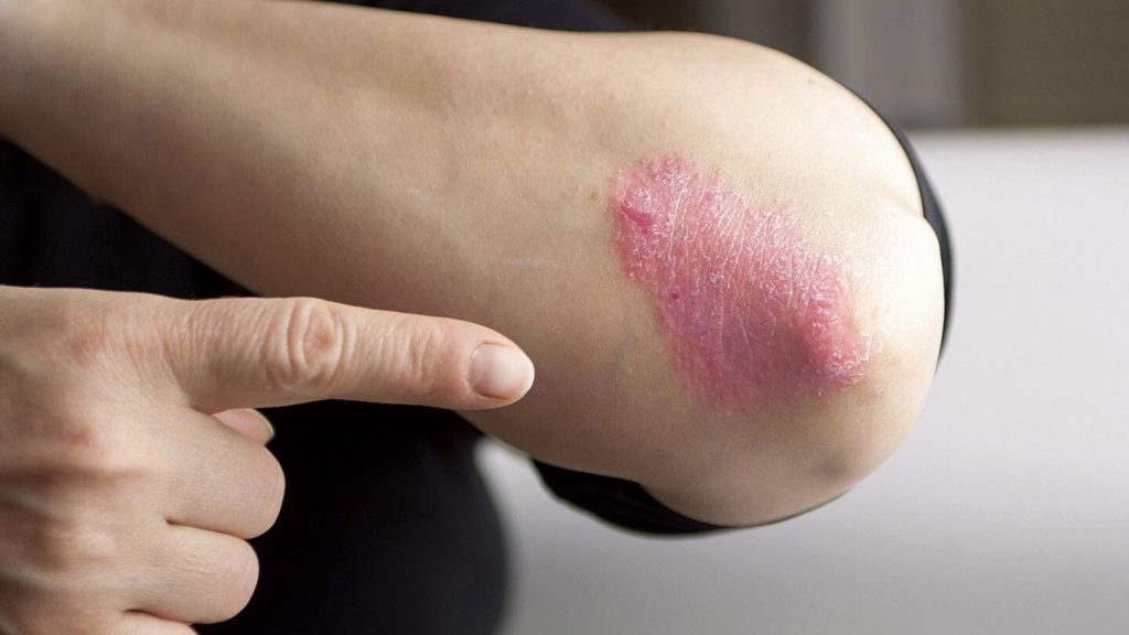List Of Different Types Of Psoriasis And Its Treatment ...