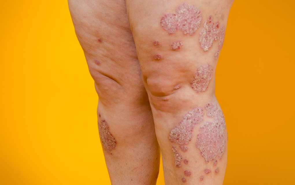 Living with Psoriasis