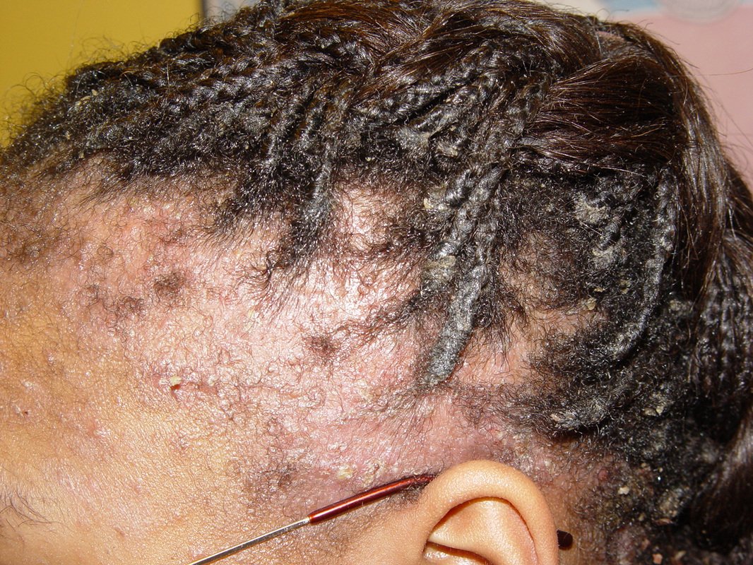 Managing natural hair and scalp seborrhoeic dermatitis ...