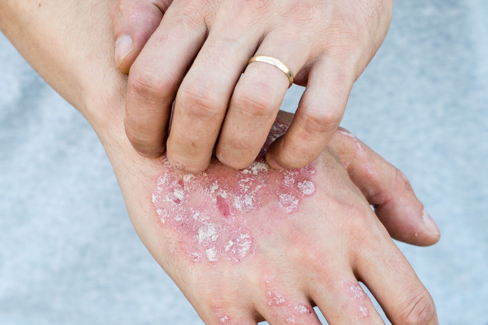 Managing Your Psoriasis Flare