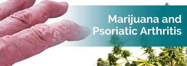 Marijuana for Psoriatic Arthritis