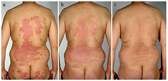 Marked improvement of psoriasis during treatment with ...